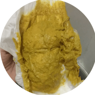 别等了赶紧送医院 宝宝拉出这种便便可能有异常