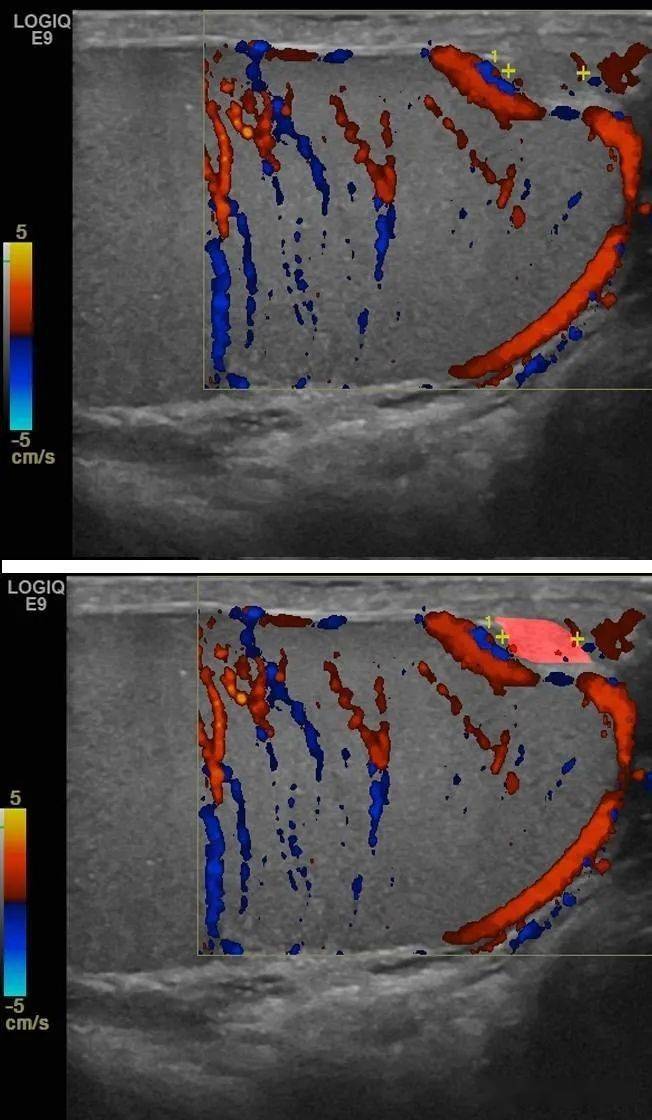图3白膜腺瘤样瘤的"晶状体征".图4 白膜钙乳囊肿的"晶状体征".