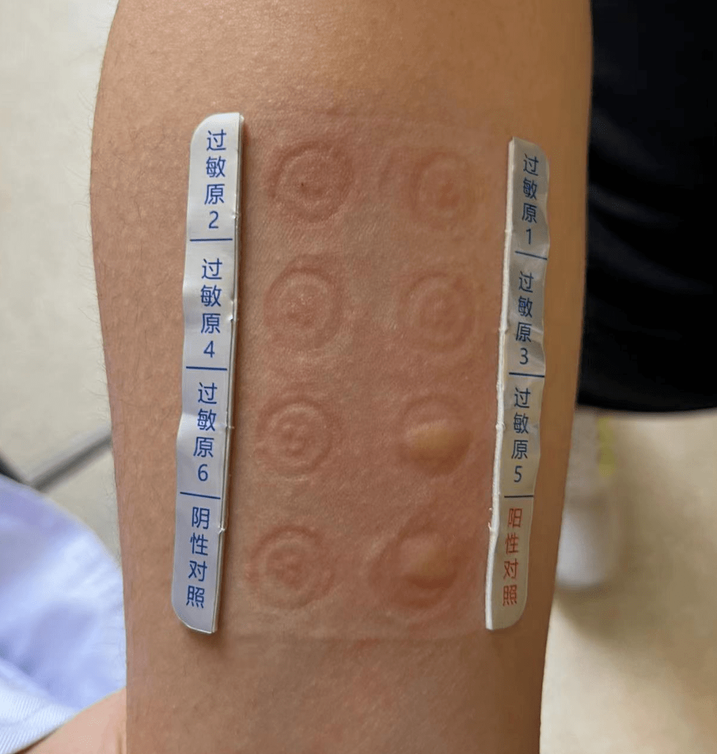 康达医院耳鼻喉科率先开展鼻炎过敏原检测,为学子安全度假保驾护航