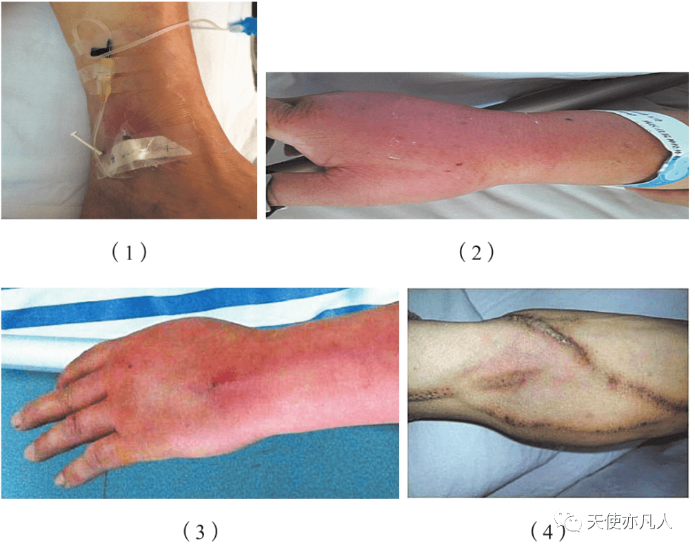 留置针静脉炎图片