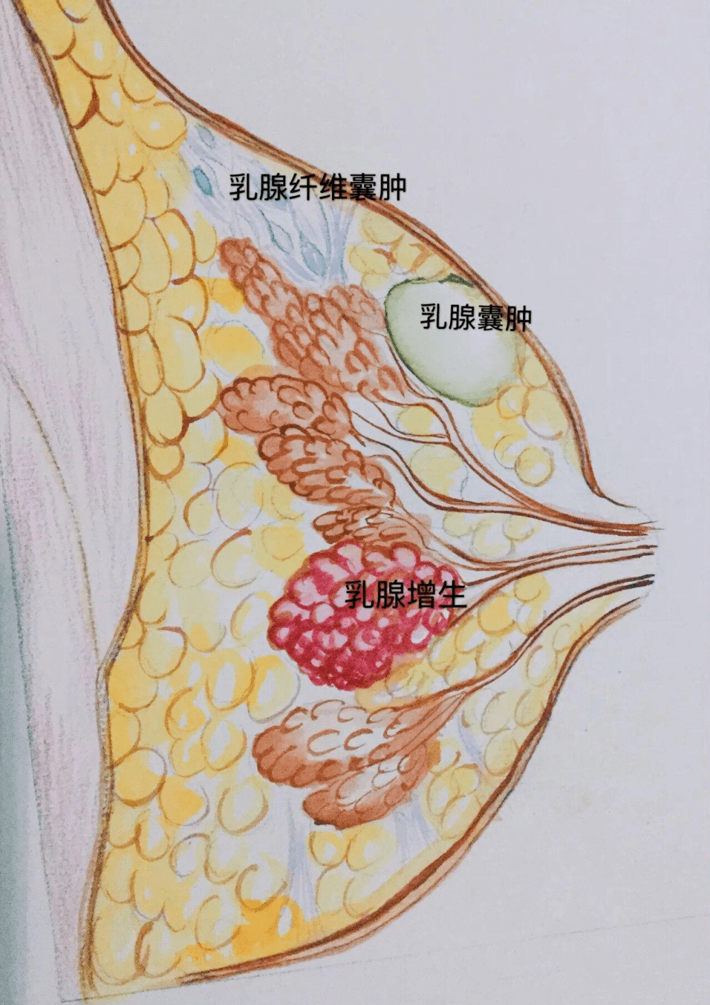 乳腺病有什么症状图片图片