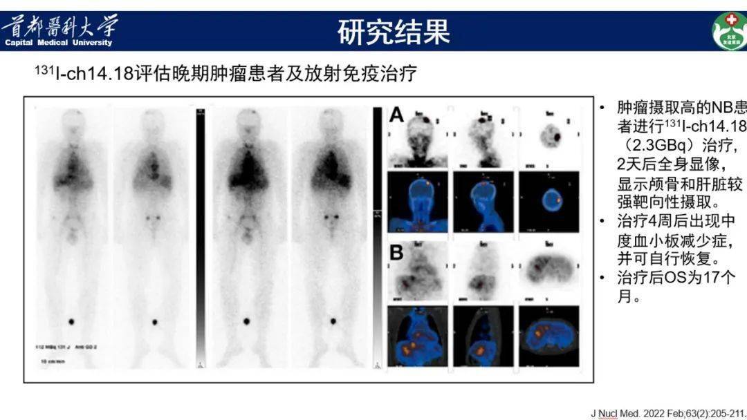 18放射性核素显像评价晚期肿瘤患者放射免疫治疗的选择_感觉神经_研究