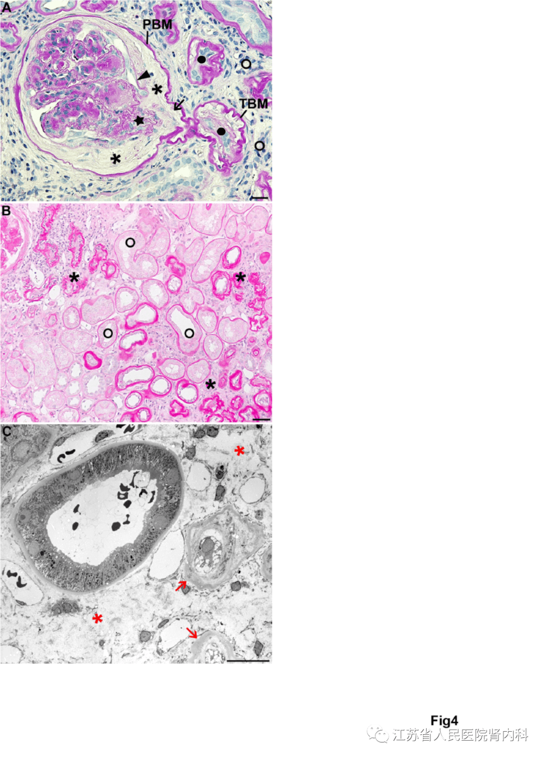 【文献速递】人类糖尿病肾病复杂病理过程的观念更新