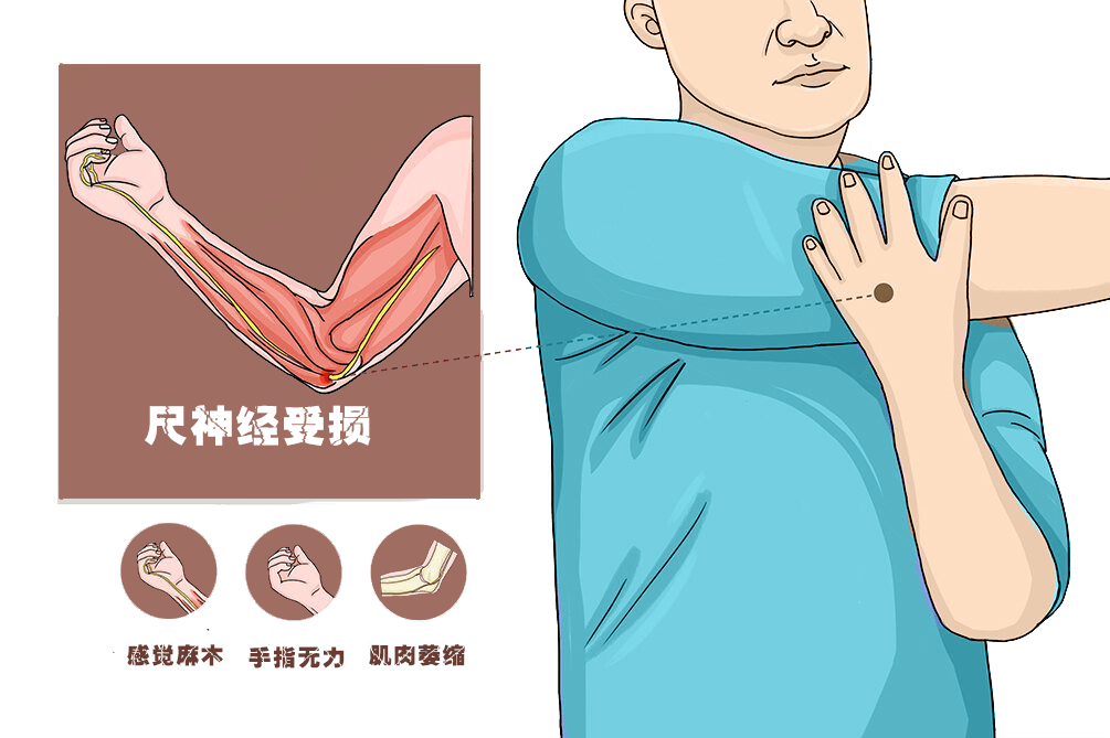 很容易因为骨折,刀伤,肘部支撑受压等原因而受损,称之为"肘管综合征"