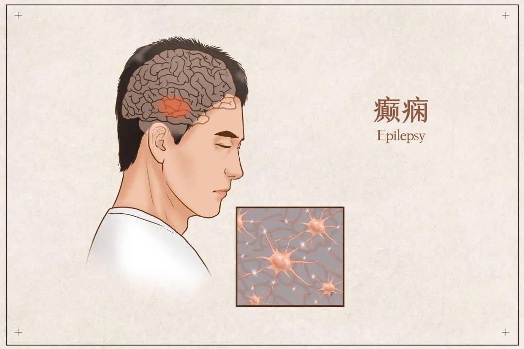 肠道菌群——癫痫治疗的关键_患者_相互作用_难治性