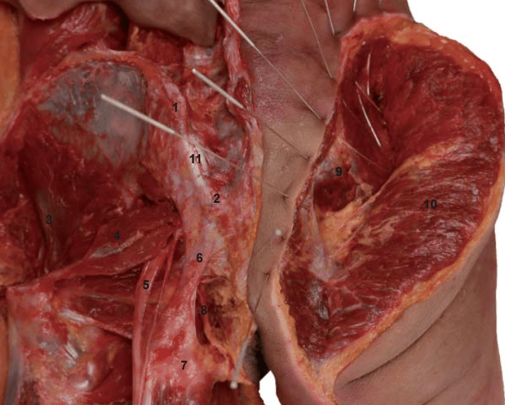 【书摘】臀内后侧的银质针治疗方法_针刺_软组织_骨盆