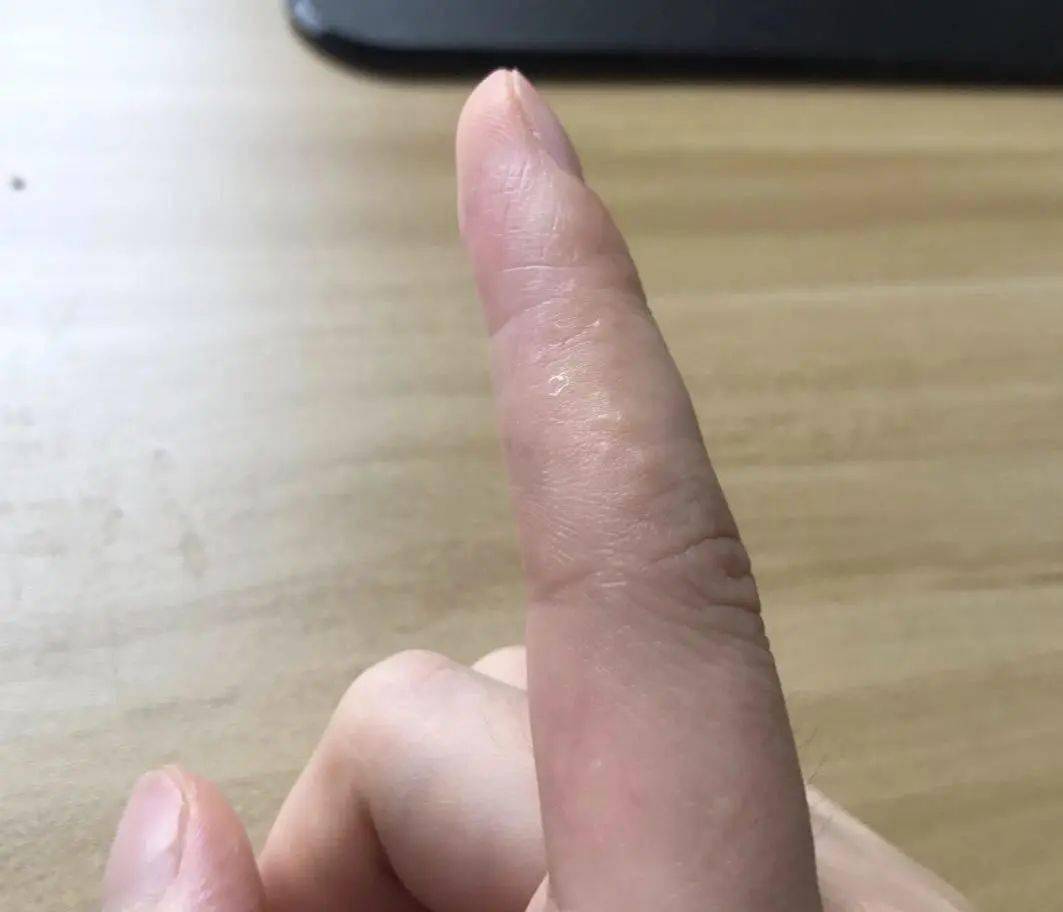 比如:糠酸酸莫米松或丙酸氟替卡松,再配合使用维生素e霜,尿素维e乳膏