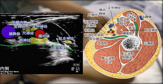 超声股神经阻滞图片