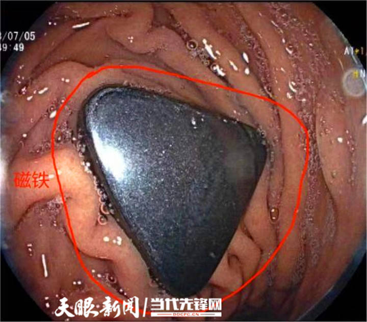 吞了一块磁铁会怎么样=吞下磁铁可以拉出来吗?
