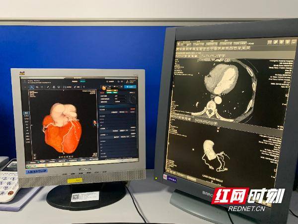 以心脏冠脉cta检查为例,以往患者检查完后,阅片医生除了对采集的影像