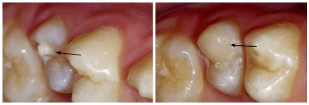 【科普】警惕萌牙期的"定时炸弹"_牙齿_中央尖_畸形