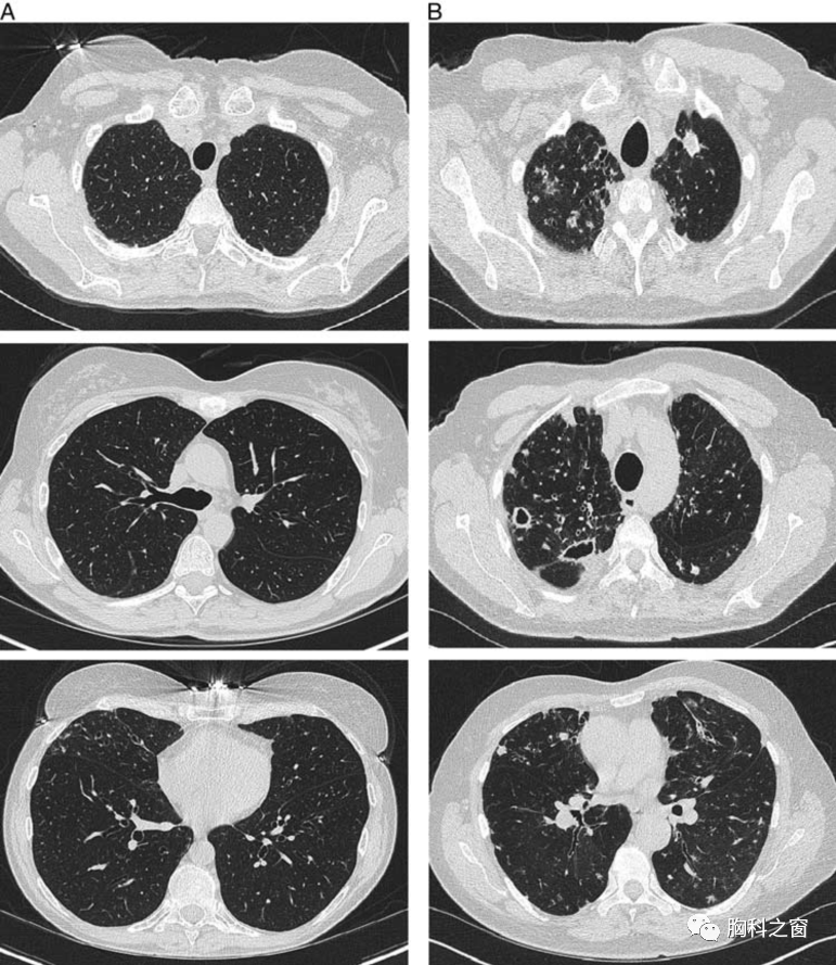 非结核性肺分枝杆菌病与无症状定植胸部ct特征:一项横断面队列研究