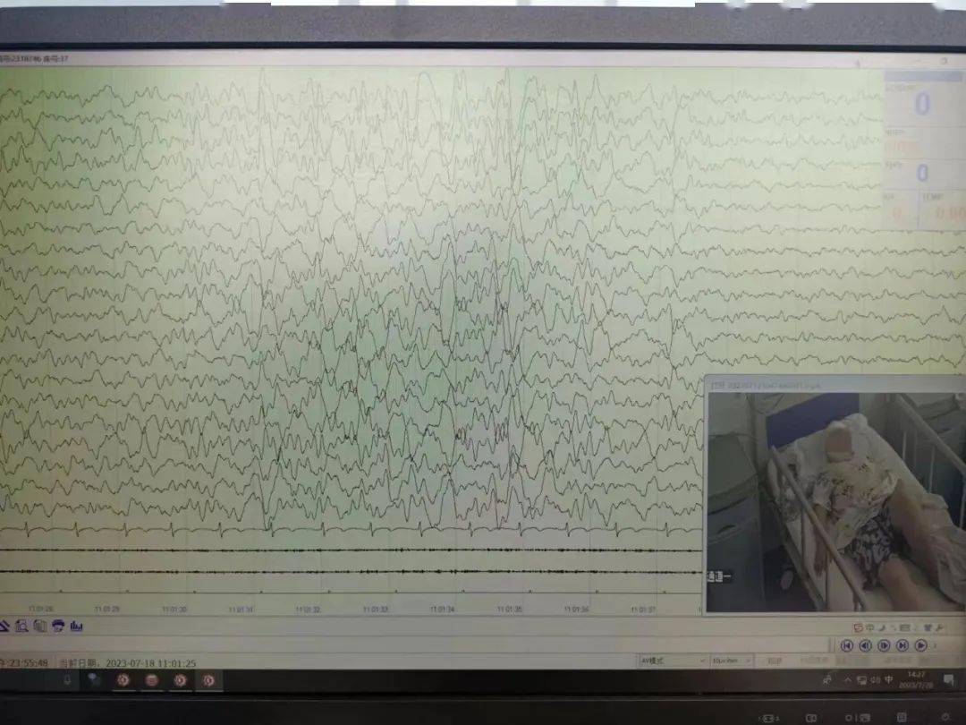 为了查明病因,给患者进行了24小时视频脑电图检查