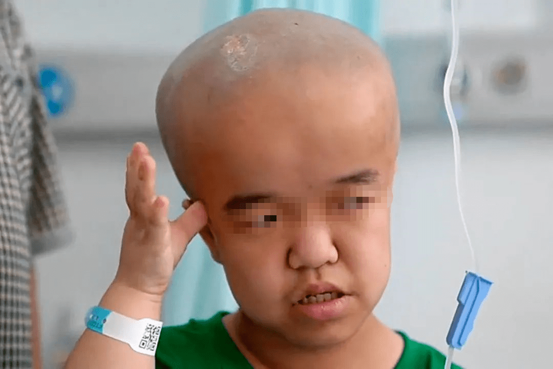 29万婴儿被三聚氰胺毒害, 变"大头娃娃", 如今怎么样了?