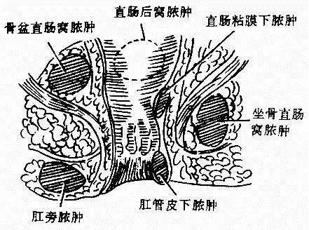 直肠隐窝的位置示意图图片