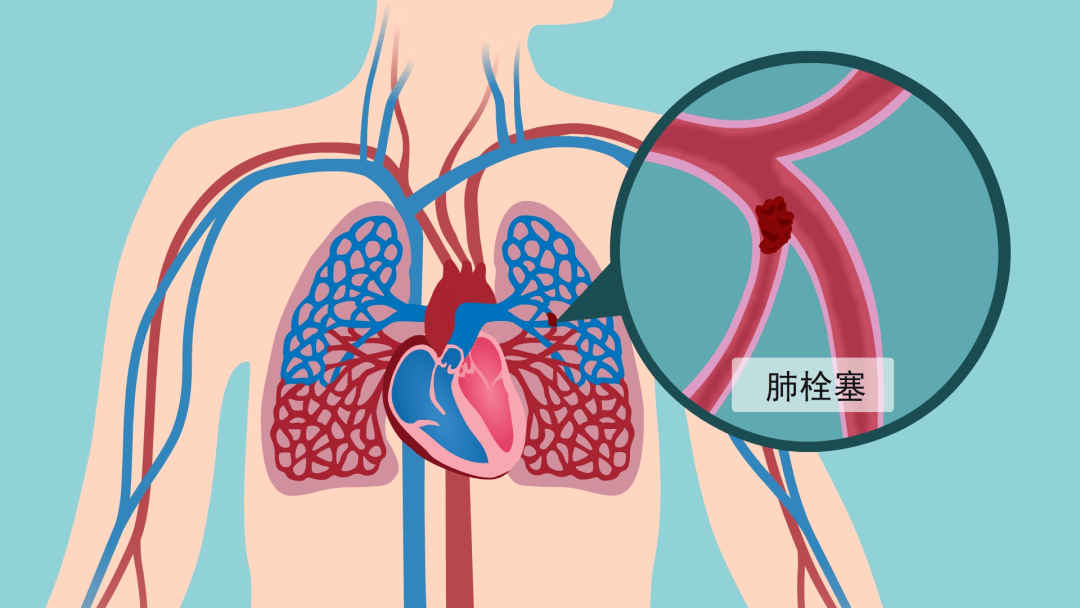 空气栓塞心脏图片图片