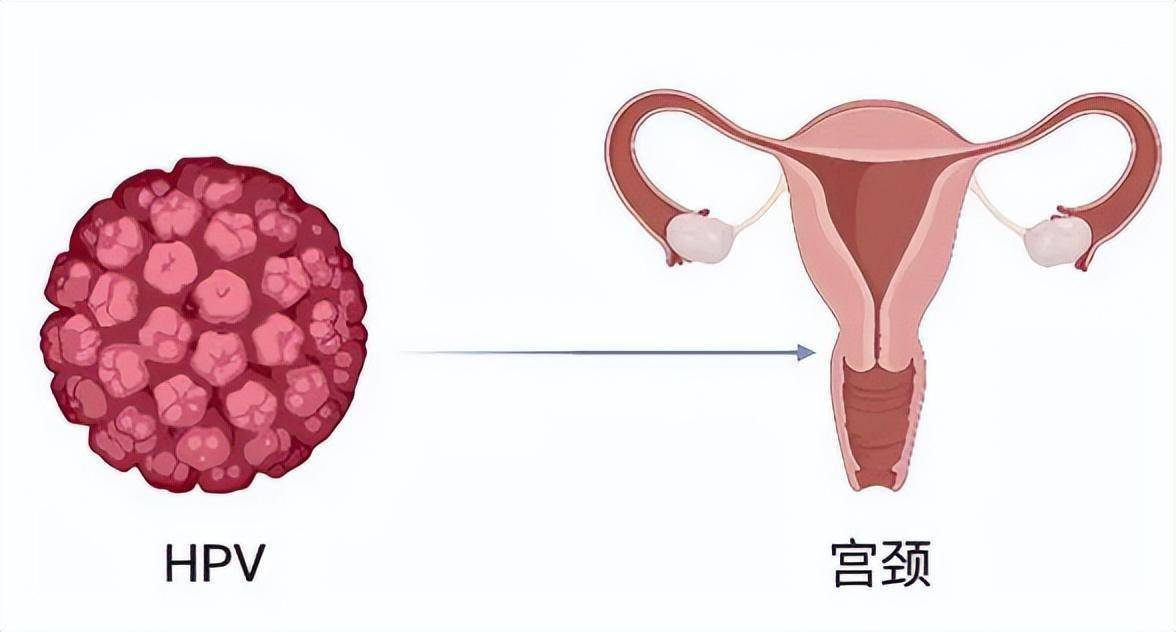 内生型宫颈癌图片图片