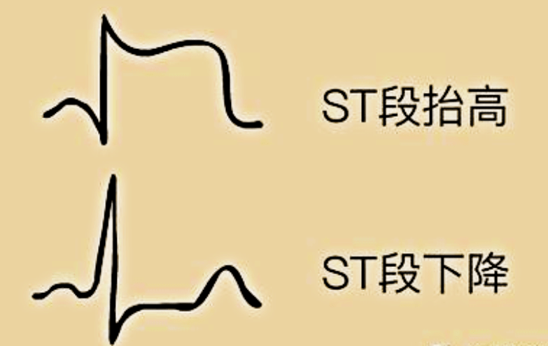 阶段,在心肌出现缺血或者坏死时,最早引起的就是心电图上的st
