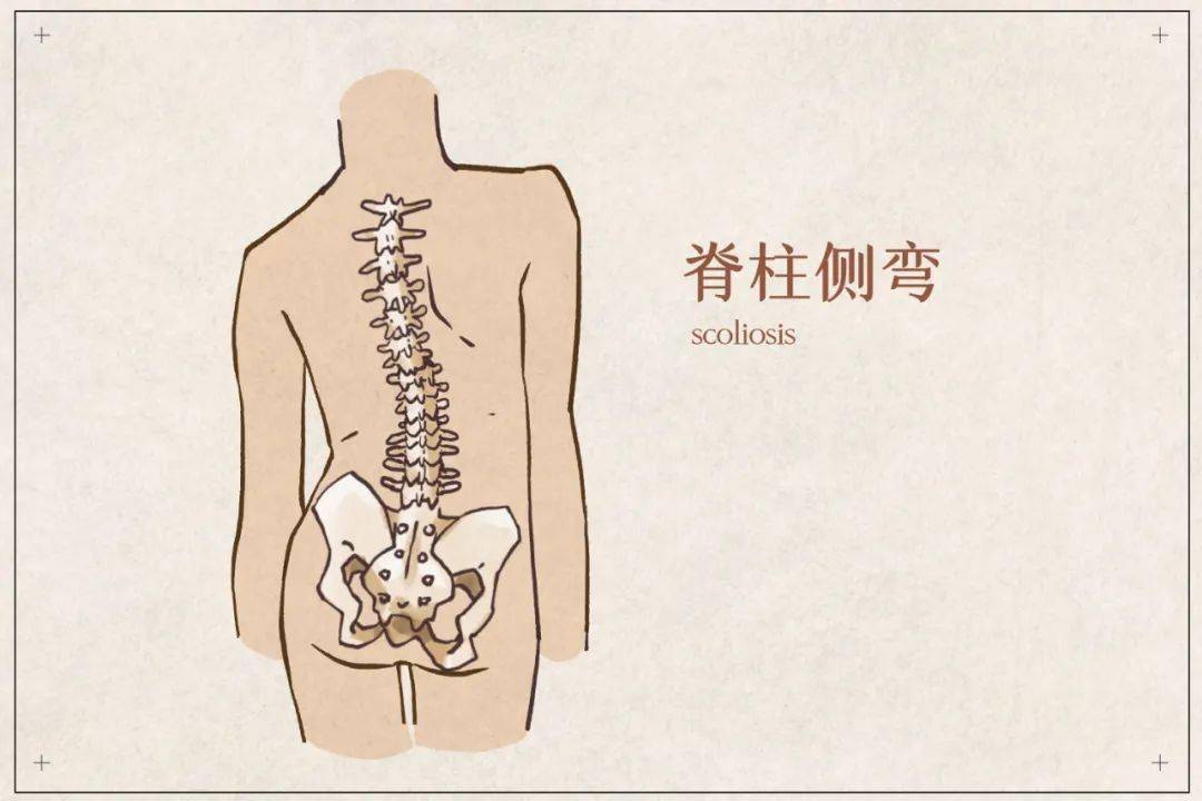 脊柱一侧肌肉凸起图片