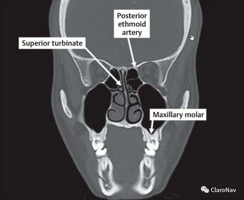 鼻窦钩突图片