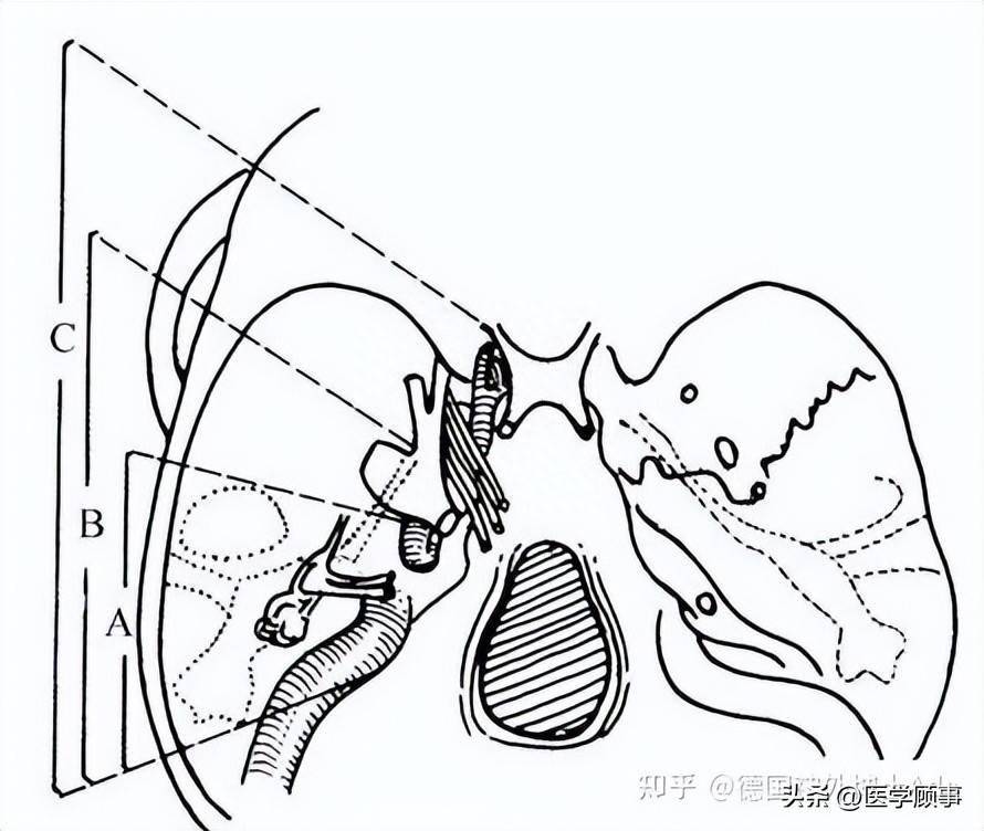 深入解读颈静脉孔区后方,侧方及前方5大手术入路_乙状窦_神经_病变