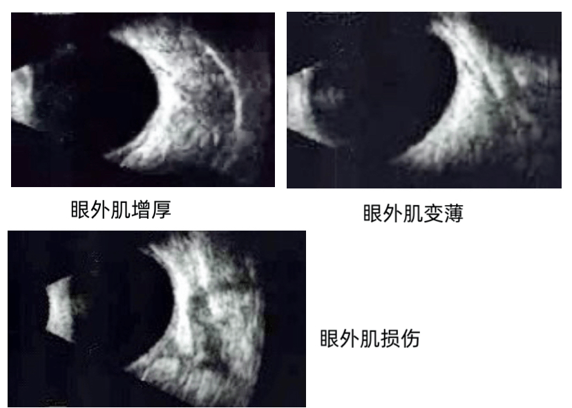 眼科b超图谱汇总