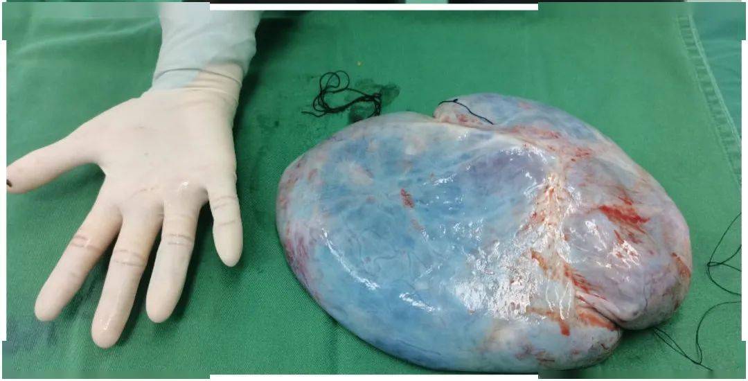 突破高龄禁区!康达医院为95岁老太成功切除盆腔内巨大包块