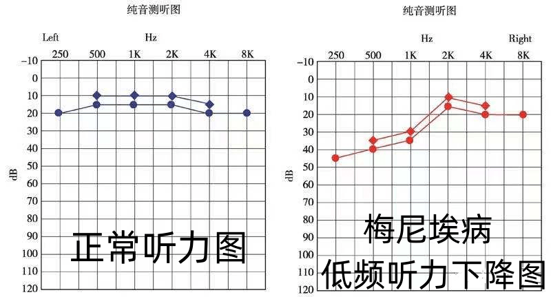 早期眩晕发作时听力明显下降,间歇期听力部分恢复,后期听力永久丧失.