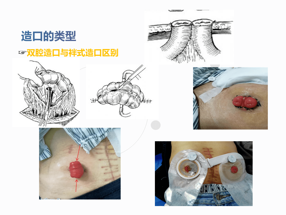 【ppt】一例结肠癌术后肠造口缺血坏死护理查房