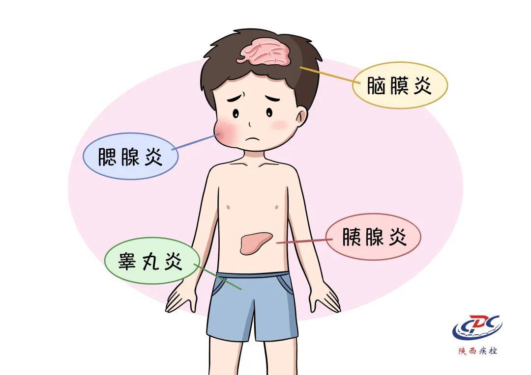 值得关注的是腮腺炎病毒除了侵犯腮腺外,还能侵犯神经系统及各种腺体