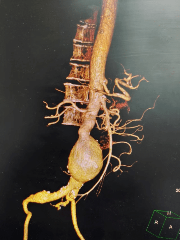 难以察觉却又致命的腹主动脉瘤_血管_治疗_综合