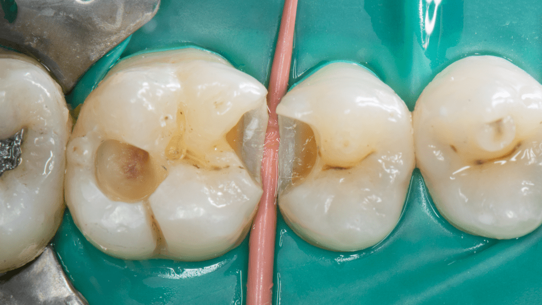 全国决赛12强病例展示 廖俊 上颌后牙ii类洞纳美树脂充填一例