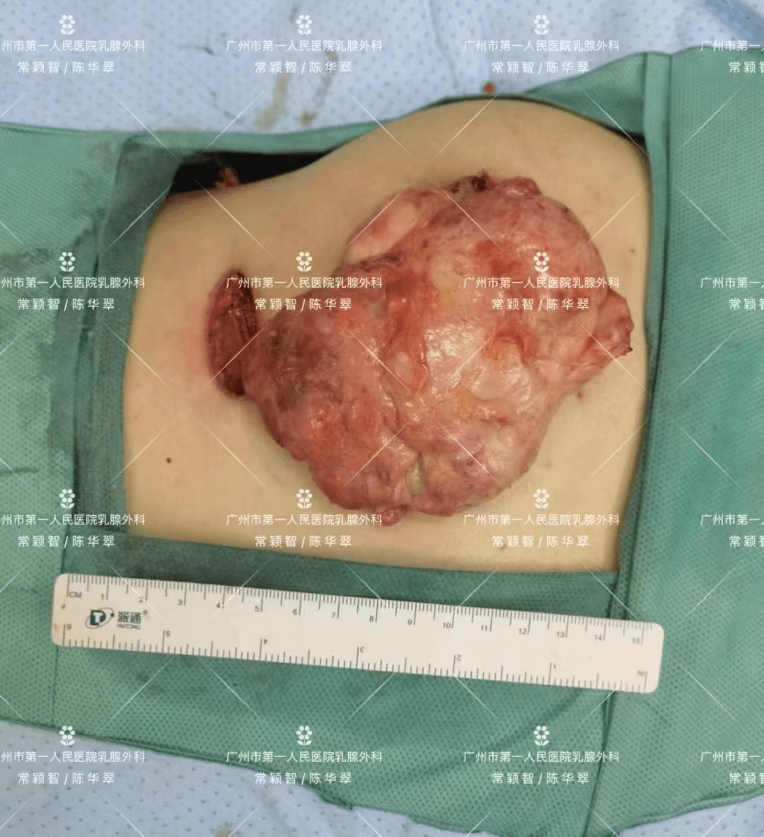 乳房包块切除术图片