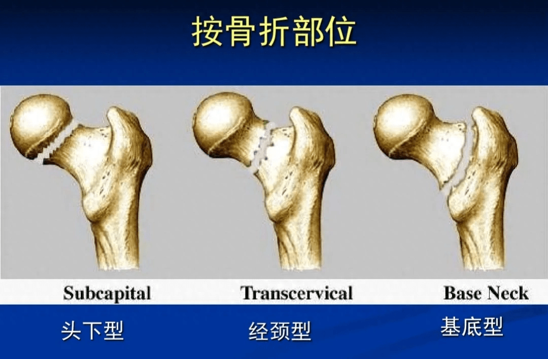 股骨颈骨折基底型图片