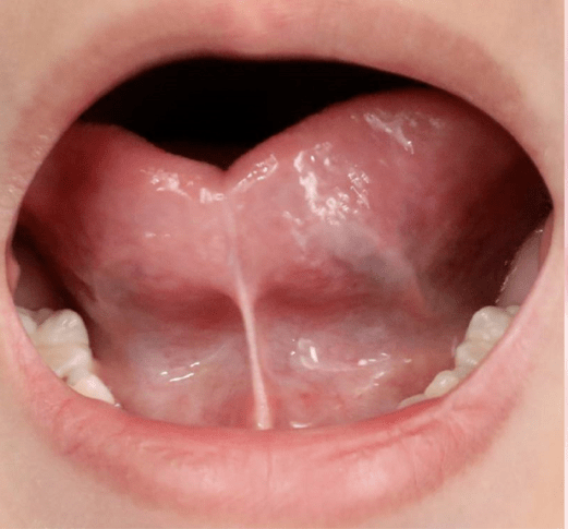 正常情况下新生儿的舌系带靠近舌尖,其后随着孩子的生长发育逐渐向
