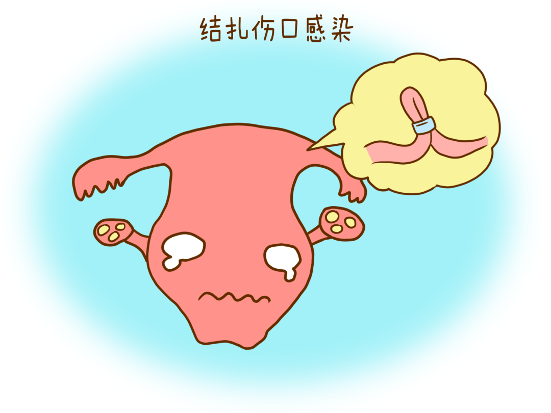 不吃药"的避孕方式,却让很多男的接受不了_男性_输精管_结扎手术