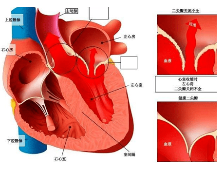 二尖瓣尖瓣图片