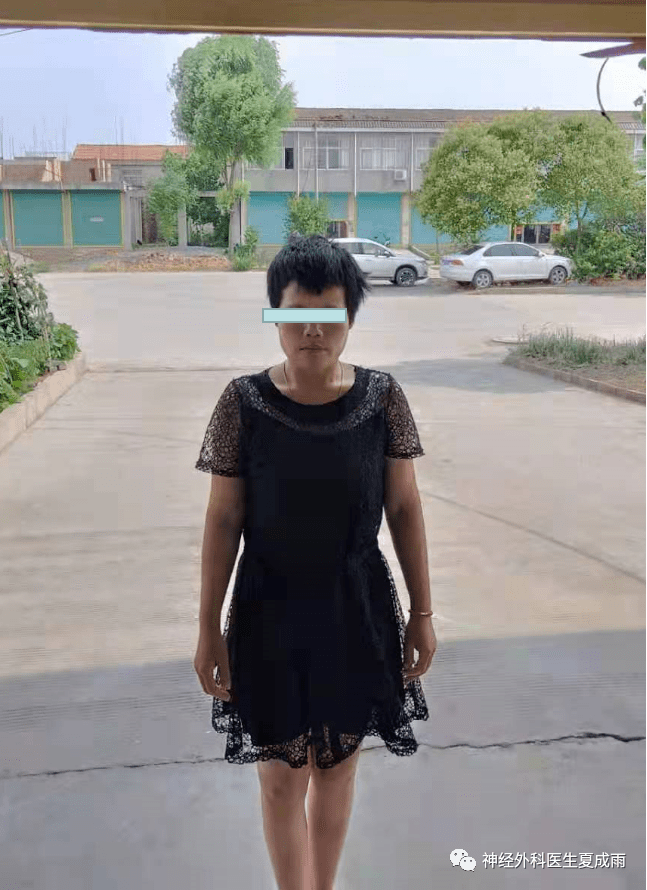 手术前沿 | 窦汇区肿瘤全切除的手术心得 - 夏成雨_残留_静脉_病例