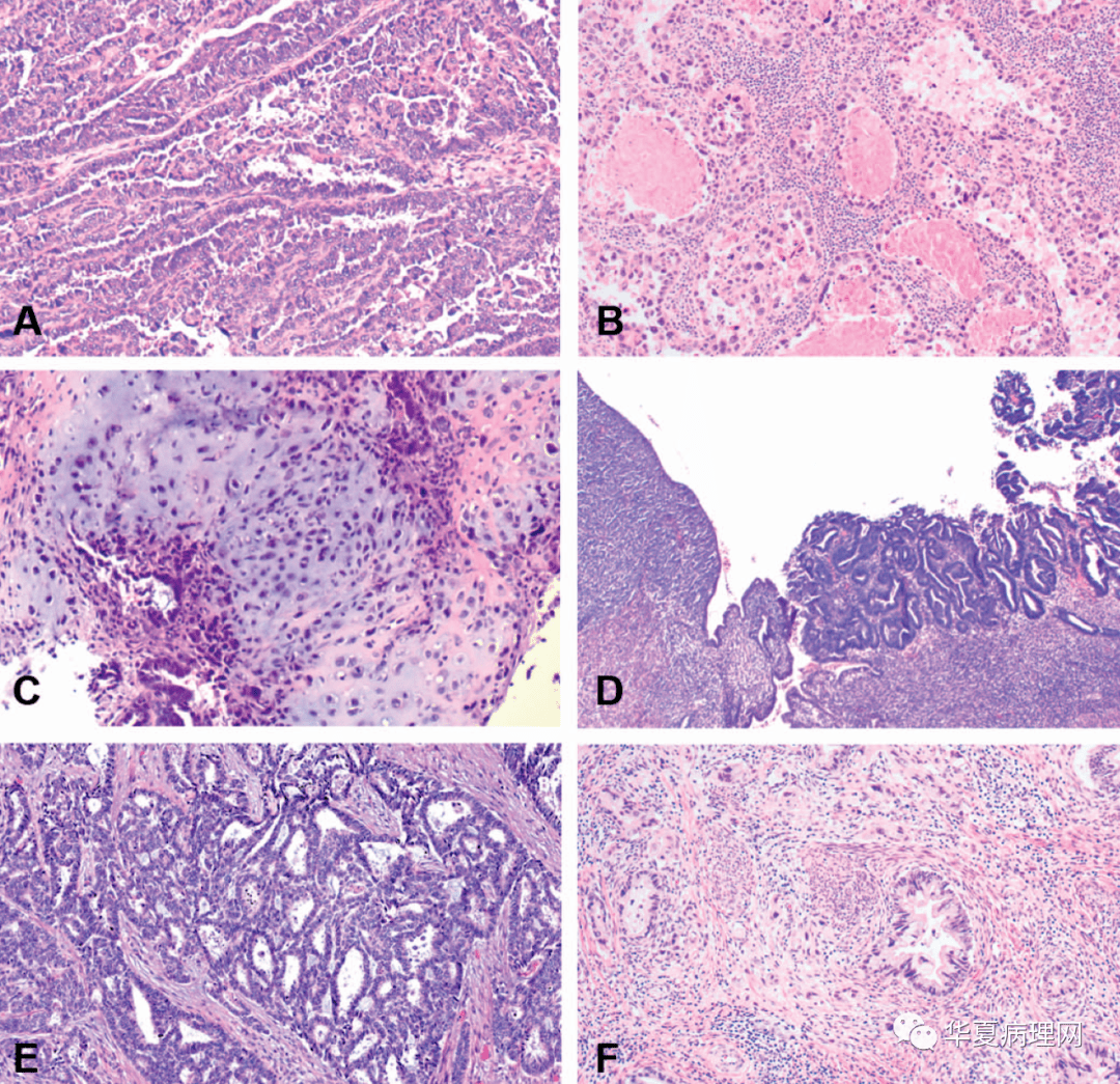 子宫内膜癌病理知识
