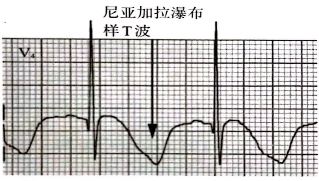 心电图鱼钩样表现图片