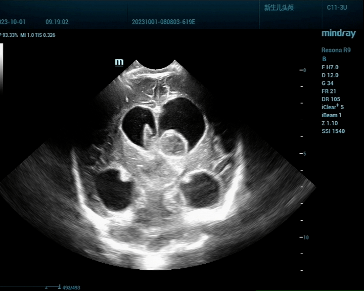 第四脑室超声图片图片
