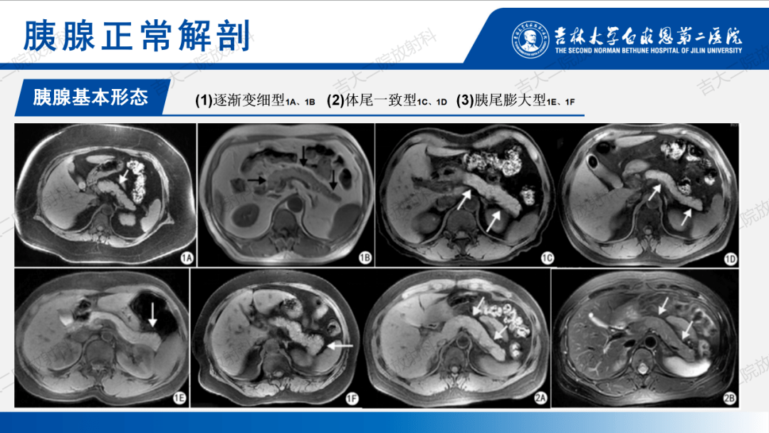 胰腺正常解剖及解剖变异影像学表现