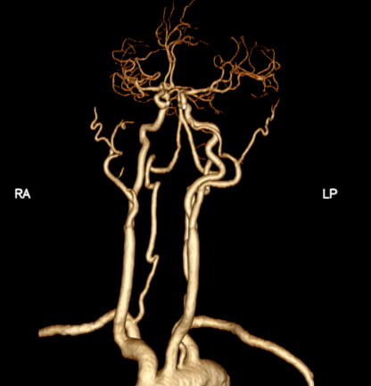 大脑后动脉狭窄图片