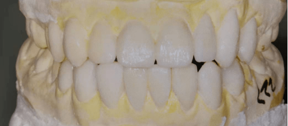 第二次就诊:医生根据诊断蜡型与患者沟通修复后可能呈现的牙齿形态,与