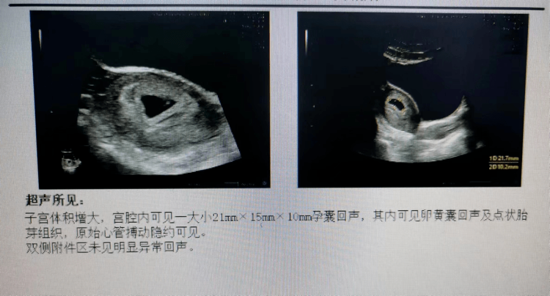 經過多次手術的她,輸卵管疏通後還能懷上孩子嗎?_女士_李彥_進行