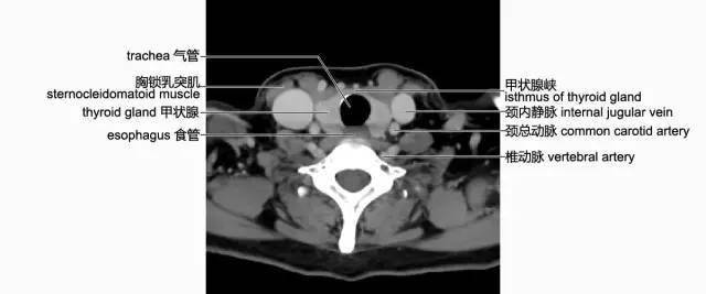 頸部影像解剖(必點收藏)_會厭_層面_頸椎