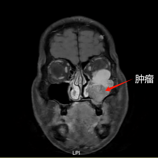 刘先生_鼻窦_手术