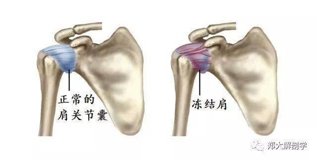 肩關節的疼痛綜合徵_關節炎_患者_活動