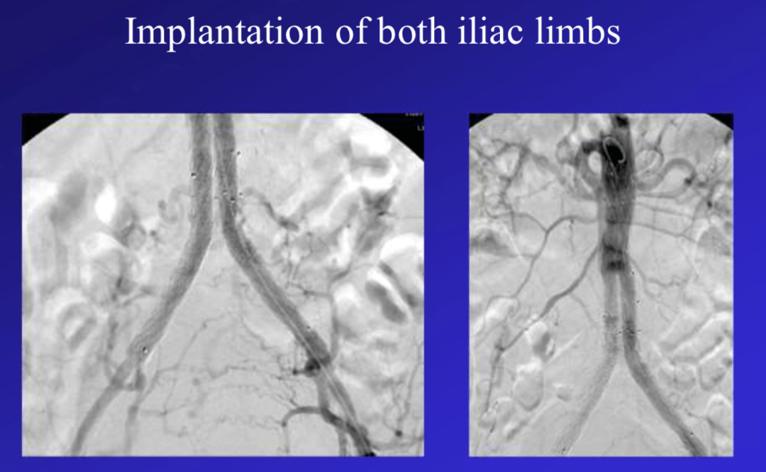 veith 2023|incraft支架用于标准肾下evar最新数据——low profile是