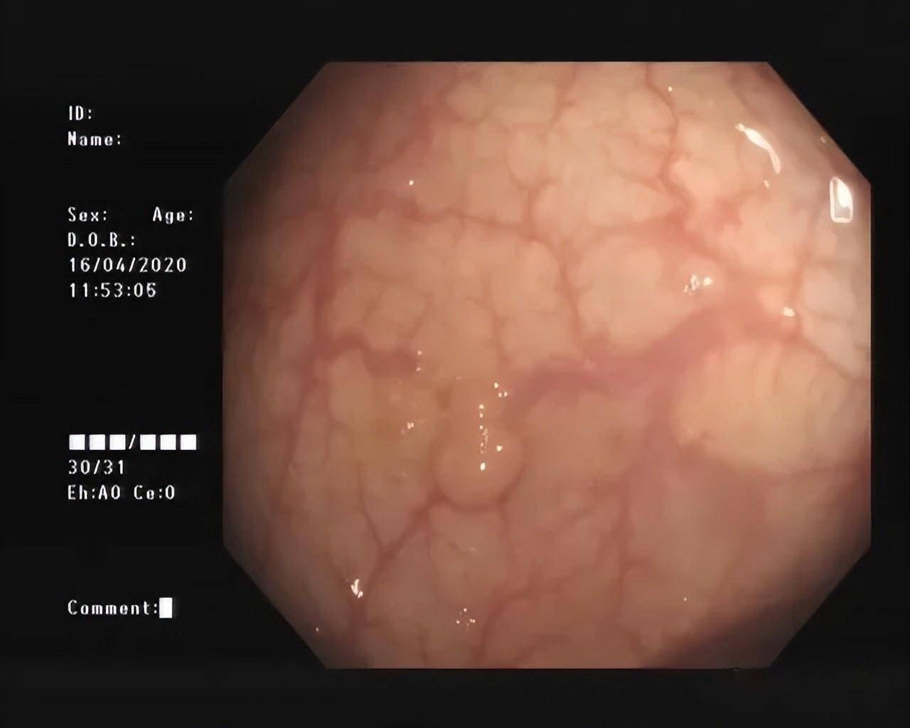 2019年12月27日中山六院的肠镜显示:直肠距肛缘12cm